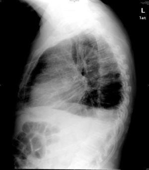 Radiografía lateral de tórax.