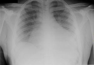 Radiografía de tórax: cardiomegalia grado II y edema intersticial en contexto de descompensación cardíaca aguda. Elaboración propia.