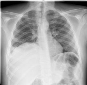 Radiografía posteroanterior de tórax: elevación del hemidiafragma derecho.