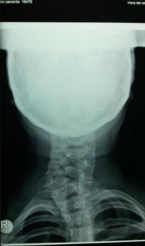 Radiografía posteroanterior de columna cervical.