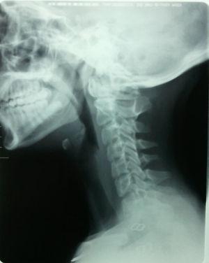 Radiografía lateral de columna cervical.