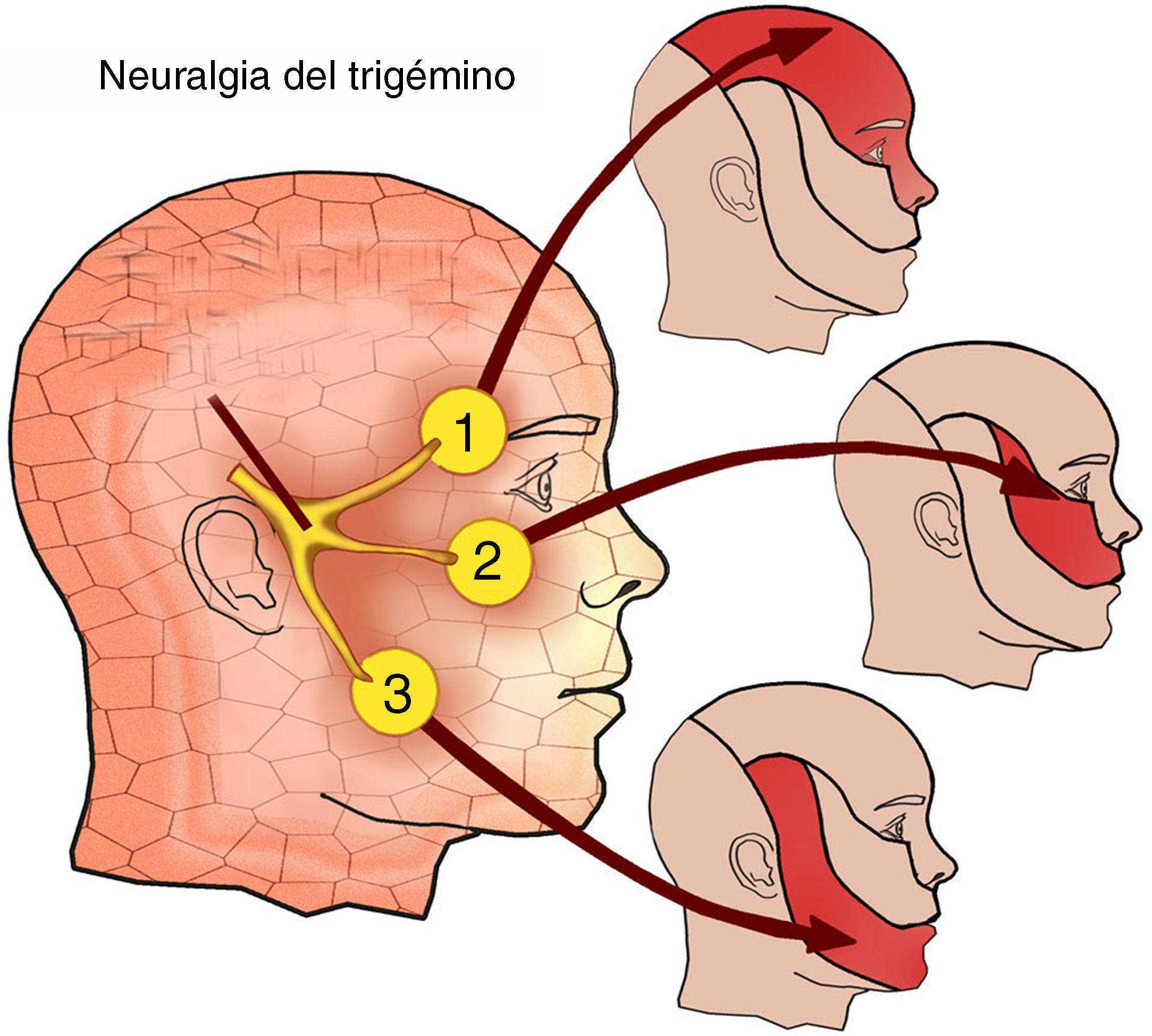 Actualización en el manejo de la neuralgia del trigémino | Medicina de Familia. SEMERGEN