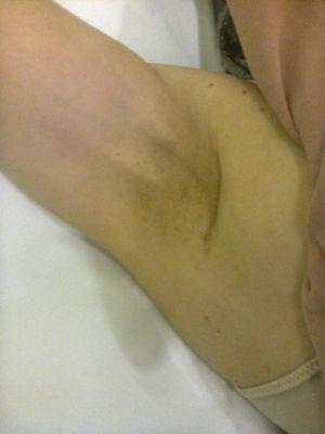 Imagen de cordones fibrosos desde la cicatriz axilar hasta la región interna del tercio distal del brazo.