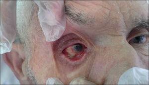 Phthisis bulbi o subatrofia del globo ocular.