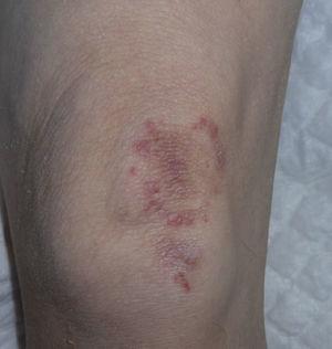 Lesión típica de granuloma de Majocchi.