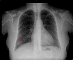 En la radiografía de tórax no se apreció ninguna imagen de condensación en la base izquierda pero sí un nódulo pulmonar solitario (de unos 29,6mm) en la base derecha (flecha).