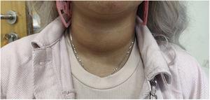 Goiter exhibited by the patient that triggered suspicion of hyperthyroidism as the cause of the tachycardia.