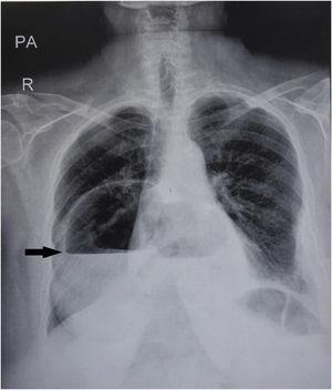 Posteroanterior chest X-ray that shows an air–liquid shadow on the right hemithorax (black arrow).