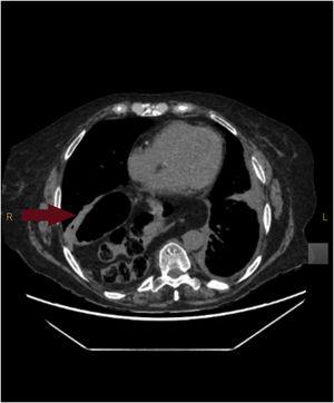 Chest computed tomographic scan showed a large hiatal hernia, containing the stomach and part of the transverse colon in posterior–inferior position of the right hemithorax (red arrow).