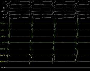 ECG de la paciente con taquicardia supraventricular. Los primeros 6 canales muestran el ECG de superficie; luego los del electrograma (EGM) registrados por el seno coronario (SC) y los del catéter de ablación. Se observa una taquicardia de complejos anchos con morfología de BRIHH. En el SC se observa sobreposición del EGM ventricular y el auricular, sugiriendo una TRNAV. Los EGM obtenido del catéter de ablación muestran VA en el His de 40ms.