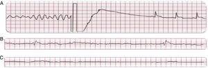 En A: Fibrilación ventricular y desfibrilación exitosa en un paciente con infarto agudo de miocardio y paro cardiaco súbito. En B y C: Ritmo agónico y asistolia en un paciente con insuficiencia cardiaca y paro cardiaco súbito.