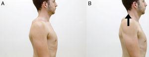 Shrug exercises and retraction. Exercise starts with the individual with the arms at the side of the trunk and shoulders in retraction (A). Perform the shrug movement (B) and return to the starting position.