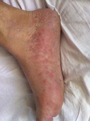 Macular rashes on feet.