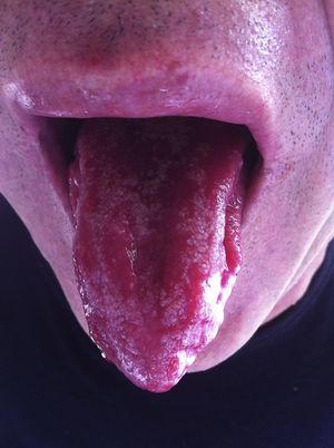 Rusty tongue.