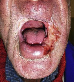Clinical examination. An extensive ulcer on the left lip commissure.