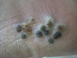 Multiple yellowish-brown papules and nodules with central black spots (the posterior end of the fleas) and indurated halos on the patient's left sole. Xerosis is also observed.
