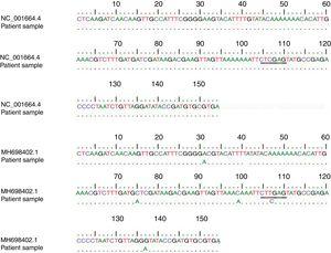 Alignment of patients’ samples sequence with HHV-6A (NC_001664.4) and HHV-6B (MH698402.1) sequences in the GenBank database. Underlined letters indicate the position of the restriction site sequence.