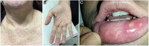 Mucocutaneous involvement during acute ZIKV infection (A) Maculopapular rash; (B) Palm rash; (C) Oral ulcers in a co-infected patient with ZIKV and CHIKV.