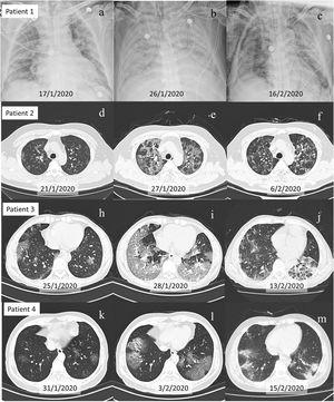 Evolution of chest X-ray and CT scans of four patients with viremia. Figure (a–c), Figure (d–f), Figure (h–j), and Figure (l–n) show chest X-ray and CT scans of patient 1, 2, 3 and 4, respectively. Figure (a), Figure (d), Figure (h), and Figure (k) show mild lesions on admission. Figure (b), Figure (e), Figure (i) and Figure (l) show excessive new ground-glass exudate on CT scans the same or next day positive SARS-CoV-2 nucleic acid test in blood was first detected. Figure (c), Figure (f), Figure (j) and Figure (m) demonstrated recovery of pneumonia after SARS-CoV-2 nucleic acid becoming negative in blood. For patient 1, even after pneumonia was some what improved in Figure (c), other organs dysfunction persistently was observed due to extended viremia.