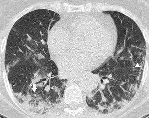 Unenhanced CT was obtained 14 days after the onset of symptoms. Manifestations of OP with patchy areas of subpleural consolidation showing perilobular distribution (arrow), with associated reticular opacities (arrowhead).
