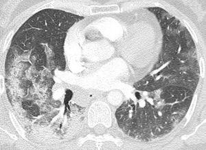 Pulmonary CT angiography on illness day 14. A pattern of OP is seen in the right middle and right lower lobes (consolidation and ground-glass opacities with perilobular distribution). Patchy areas of ground-glass opacities in the left lung. No signs of PE.
