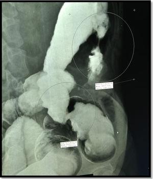 Barium enema. Two small and narrow strictures in descending and transverse colon (circles).