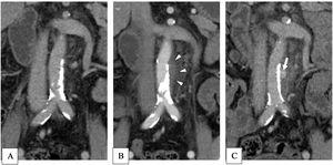 (A) The abdominal CT scan reveals the atherosclerotic change of the abdominal aorta and the common iliac artery. (B) (without contrast) and (C) (with contrast) show extravasation and rupture of the infected abdominal aneurysm at the third admission.