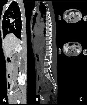 CT scan before starting treatment for tuberculosis. (A and C) Presence of cutaneous abscess; (B) Presence of osteomyelitis on the second lumbar vertebra.
