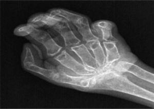 Radiografía de la mano, que evidencia intensa osteopenia sinostosis y ausencia de carpo.