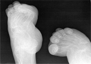 Hallazgos radiológicos en pies similares a los encontrados en las manos: osteopenia y tarso incompleto.