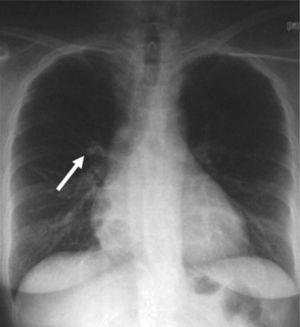 Nódulo pulmonar en el lóbulo medio en la radiografía de tórax.