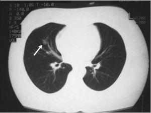 Nódulo pulmonar en el lóbulo medio visto en la tomografía computarizada.