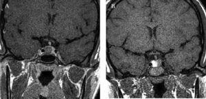 Imágenes de la resonancia magnética hipofisaria de la paciente de 19 años con acromegalia. A: prequirúrgica. B: posquirúrgica.