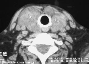 Tomografía axial computada del cuello, que muestra glándula tiroides aumentada de tamaño, con múltiples nódulos.