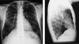 Radiografía de tórax anteroposterior y lateral año 1988.