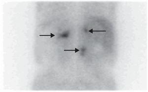 Gammagrafía con MIBG: captación a nivel de ambas suprarrenales y de la masa retroperitoneal.