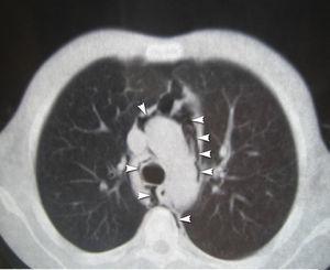Imagen de una tomografía computarizada a nivel del mediastino superior donde se visualiza la presencia de aire rodeando la tráquea, el esófago, el cayado aórtico y la vena cava superior en relación con el neumomediastino (cabezas de flecha).