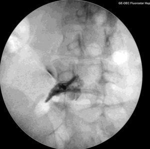 Infiltración epidural transforaminal L5-S1. Proyección radiológica oblicua lateral. Imagen de visión en túnel de la aguja a nivel foraminal y comprobación con contraste de la progresión epidural.