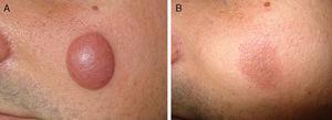 A, Brownish-red skin tumor on the left cheek, with a smooth, shiny surface. B, Complete remission of the lesion 6 weeks later, showing residual hyperpigmentation and a depressed central area corresponding to the biopsy site.