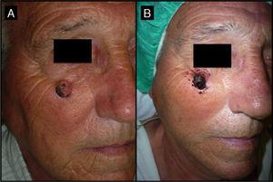 Seventy-year-old man with keratoacanthoma in the right infrapalpebral region; the tumor had appeared 4 months earlier (patient 2, Table 1). A, Tumor with a diameter of 2cm at the baseline visit. B, Tumor, now measuring 1cm, a month after neoadjuvant treatment with intralesional methotrexate.