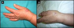 Seventy-two-year-old man with keratoacanthoma on the back of his left hand (patient 8, Table 1). A, Tumor measuring 2cm before intralesional injection of methotrexate. B, Tumor 1 month after treatment (65% reduction in size).