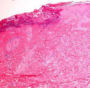 Erosion and epidermal necrosis caused by scraping. Hematoxylin–eosin, original magnification ×40.