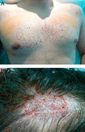 (A) Donor strip on the chest after follicular unit extraction. (B) Implantation of follicular units of body hair in the scar.