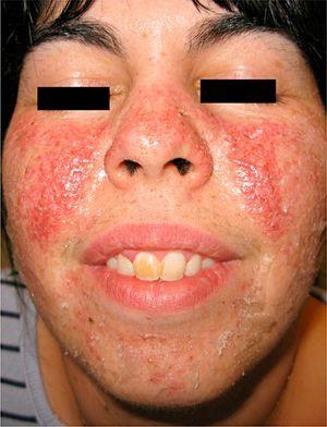 Clinical image of the lesions before the start of treatment. Multiple facial angiofibromas predominantly affecting the cheeks, with a prominent erythematous base.