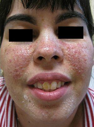 Image of the patient after 3 months of treatment with rapamycin solution (1mg/mL). Reduction in the number of lesions and marked improvement in the underlying erythema.