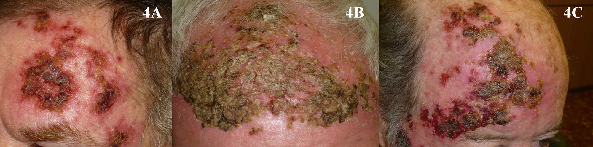 Price For Aldara Price for aldara