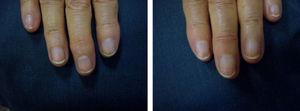 Patient from Figure 1 after 2 months of treatment with tazarotene 0.1% ointment. Note the markedly diminished nail involvement, especially the minimal presence of oil spots and the absence of onycholysis.