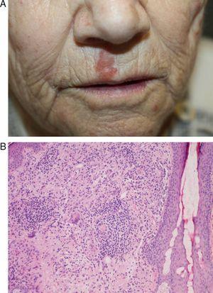 Case 3: A, Slightly infiltrated erythematous plaque with a corrugated surface, located on the right side of the upper lip. B, Granulomatous infiltrate in the superficial dermis, consisting of histiocytic growth and multinucleated-giant-cell forming loose, poorly-defined granulomas (hematoxylin-eosin, original magnification x10).