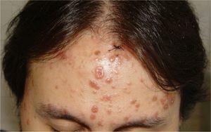 Case 9: Erythematous-violaceous papules and plaques on the site of previous varicella scars.