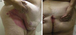 Inverse psoriasis lesions in our patient with hidradenitis suppurativa: A, in the groin and B, in the gluteal cleft.